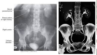 Radiographic Contrast Studies of the Urinary System [upl. by Eirahcaz]