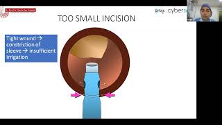 Live Surgical Demonstration Basics of Phacoemulsification  Dr Umang Mathur [upl. by Imoan]