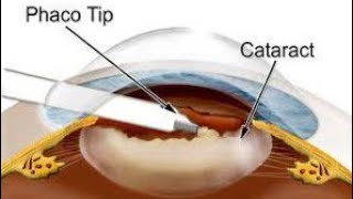 Phacoemulsification for Cataract  All you want to know about cataract surgery [upl. by Ingar]