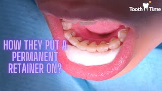 how do they put a permanent retainer on Braces at Tooth Time Family Dentistry New Braunfels [upl. by Cumine]