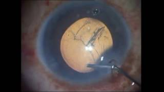 Soft cataract Phacoemulsification for beginners Soosan Jacob 4 5 min with audio [upl. by Krutz]