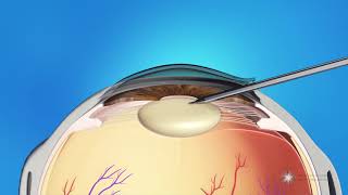 Phacoemulsification Cataract Surgery [upl. by Estas725]