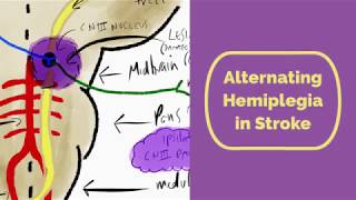 Alternating Hemiplegia in Stroke [upl. by Letitia646]