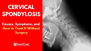 What is Multiple Sclerosis MS [upl. by Aelaza935]