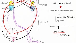 Hemiplegia CVA  Stroke  Theory amp Clinical discussion [upl. by Elissa]