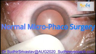 Normal MICSMicroPhacoemulsification Cataract Surgery DR SUDHIR SRIVASTAVA [upl. by Breanne]