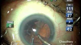 Micro incision cataract surgery MICS by phaco at Eye7 Delhi India [upl. by Enenaej]