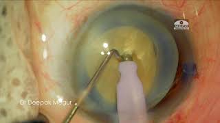 Phaco Basics Direct Chop in a Hypermature Morgagnian Cataract Principles Dr Deepak Megur [upl. by Toddy]