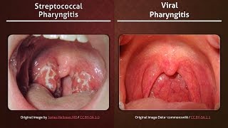 Streptococcal vs Viral Pharyngitis [upl. by Nangem797]