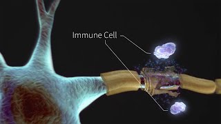 CERVICAL SPONDYLOSIS Causes Symptoms and Treatment NO SURGERY [upl. by Nonregla]