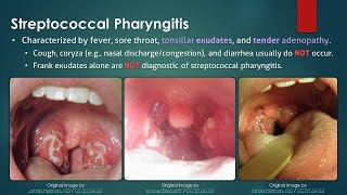 Streptococcal Pharyngitis [upl. by Nade936]