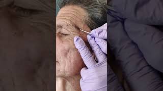 Acne extraction of blackheads and whiteheads popping pimples in Los Angeles [upl. by Germano]