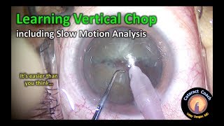 learning vertical phaco chop cataract surgery [upl. by Gnuh562]