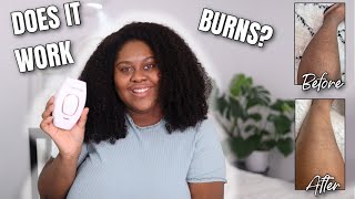 LASER HAIR REMOVAL ON DARK SKIN 4 Weeks Review  RoseSkinCo [upl. by Areema]