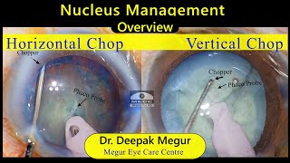 Phaco BasicsNucleus management pearls amp pitfalls  Dr Deepak Megur [upl. by Sirapal355]