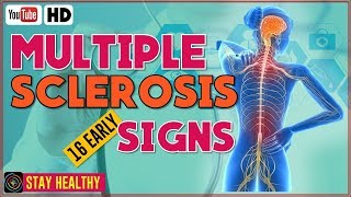 Multiple sclerosis  causes symptoms diagnosis treatment pathology [upl. by Epoillac]