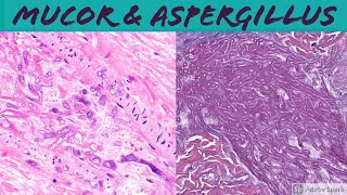 Mucormycosis amp Aspergillosis Angioinvasive Fungal Infection [upl. by Leerzej118]