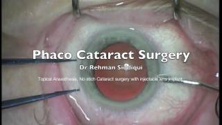 Phaco Cataract Surgery High Definition HD [upl. by Ronda]