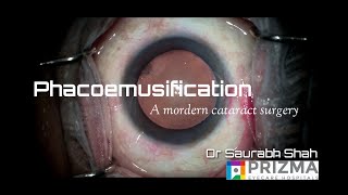 Phacoemulsification Procedure Explained  Ultramodern Cataract Surgery [upl. by Elsey229]