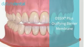 OSSIX PLUS Resorbable Collagen Dental Membrane 2014 [upl. by Daza591]