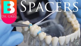 BRACES EXPLAINED Spacers [upl. by Elwood]