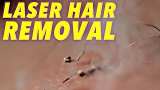 Science of Laser Hair Removal in SLOW MOTION [upl. by Andriette329]