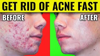 Say Goodbye to Acne Dr Bergs Proven Methods for Clearing Your Skin [upl. by Ihpen]