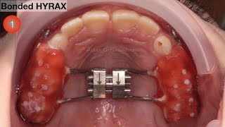 Tips for fixed retainer bonding episode no1 Quick orthodontic tips series [upl. by Cook]