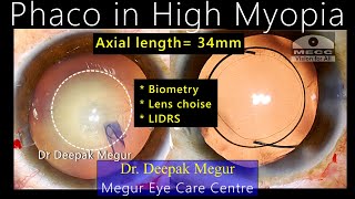 Phaco in Highly Myopic Eye Challenges amp Priorities  Dr Deepak Megur [upl. by Ignaz]