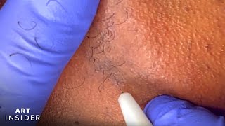 Electrolysis Permanently Removes Body Hair [upl. by Brosy873]