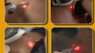 Laser Hair Removal video by Cynosure [upl. by Atteoj]