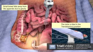 Laparoscopic Appendectomy [upl. by Attecnoc433]