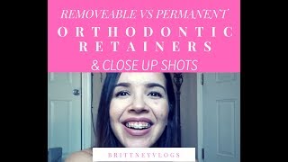 PROS amp CONS CLOSE UPs ORTHODONTIC RETAINERS BRACES UPDATE [upl. by Elfrieda]