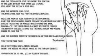 How to inject IM Selecting The Site For Injection [upl. by Eerak]