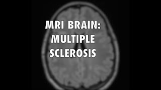 Multiple Sclerosis MRI [upl. by Taddeo]