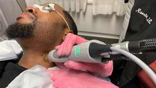 Candela Laser  Hair Removal with Safaree  New York NY  Dr Jason Emer [upl. by Enillebyam839]