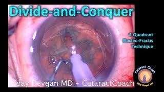 Divide and Conquer Phaco Technique for Cataract Surgery [upl. by Strade363]