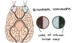 Understanding Bitemporal Hemianopia [upl. by Nairam]