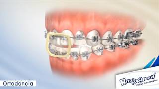 Corrección de mordida y espacios dentales quotOrtodonciaquot [upl. by Lefkowitz]