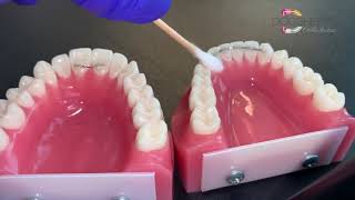 What To Do About A Loose Permanent Retainer  Dougherty Orthodontics St Louis Missouri [upl. by Nirot]