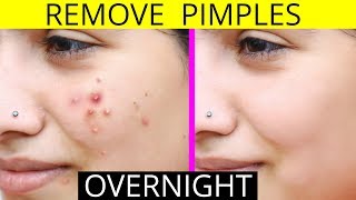 How To Remove Pimples Overnight  Acne Treatment  Anaysa [upl. by Adnesor448]