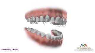 Orthodontic Retainer  Hawley  Instruction and Care [upl. by Saint]