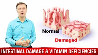 Intestinal Obstruction amp Vitamin Deficiencies – Dr Berg [upl. by Weisbart]