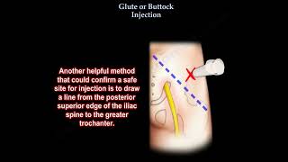 Glute injection buttock injection [upl. by Ahsia]