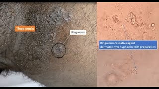 Ringworm and its causative agent dermatophyte under microscope [upl. by Ahseen]