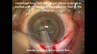 iH during phacoemulsification cataract surgery  ID 124528 [upl. by Ellemrac]