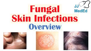 Overview of Fungal Skin Infections  Tinea Infections [upl. by Nekcarb]