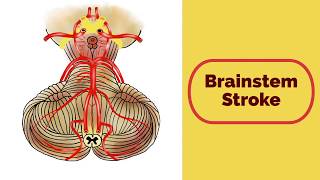 Brainstem Stroke Syndromes [upl. by Pepe]