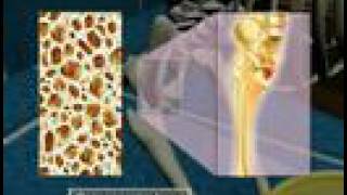 Osteoporosis3D Medical Animation [upl. by Eneja]