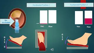 Basics of Phaco  Part I for Part II httpswwwyoutubecomwatchvUY6ZdPKPaJ4 quickguideorg [upl. by Ilanos]